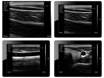VIATOM LÍNÚR ÞRÓTTUR PORTABLE ULTRASOUND - 33931