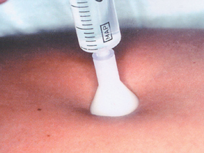 S.I.T. HÚÐSPRAUTUNARÞJÓNUSTA 31G 0,26X2.5 mm - hvítur – mynd 2