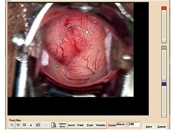 COLPOSCOPY SOFTVER fyrir 29620, 29622, 29600 með 29603 - 9621