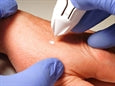 CRYOCLEAR FRYSTITÆKI með 16 g hylki – mynd 4