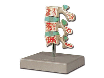 ADVANCED OSTEOPOROSIS - 40185